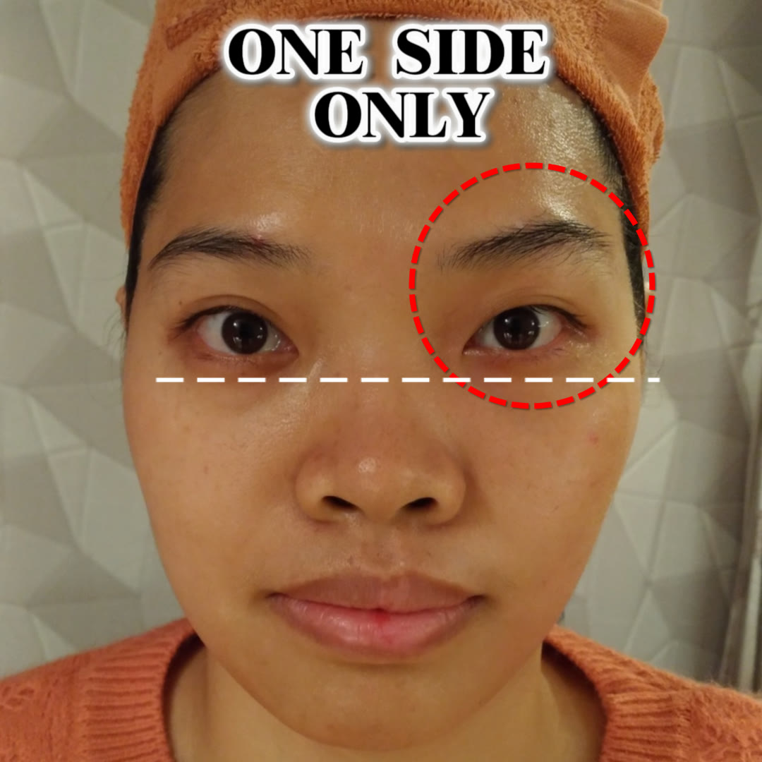 One side of the face worked for five minutes — the circled eye area looks more open and lifted than the untouched side