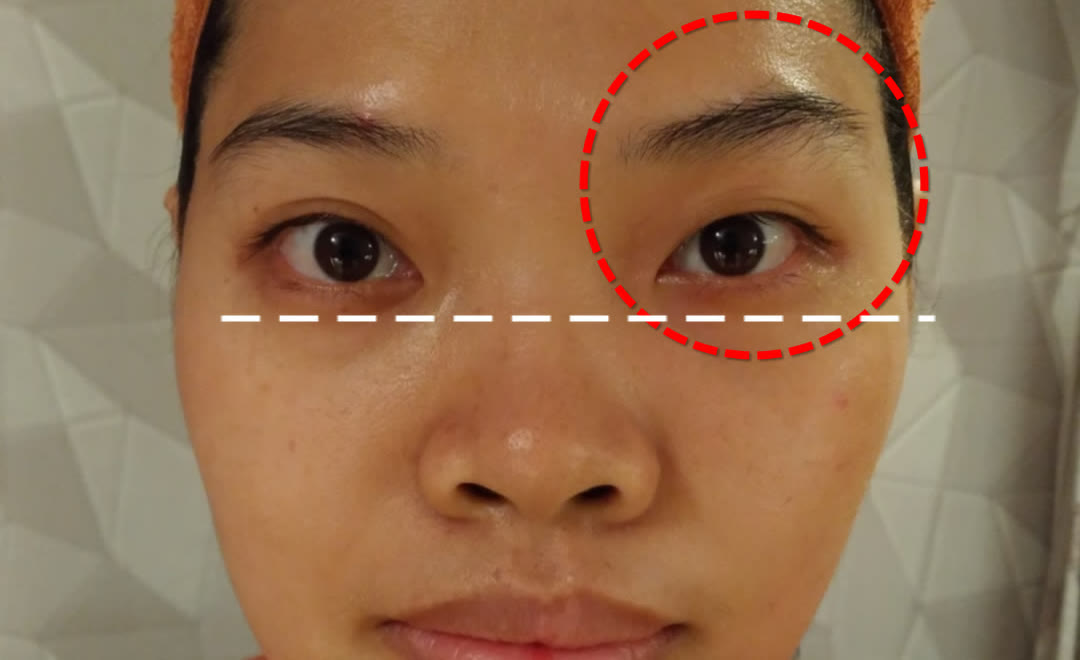 One eye area worked for five minutes, marked with a dashed line and circle, next to the untouched side